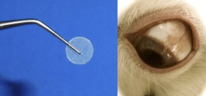 glaucoma