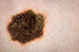 melanoma